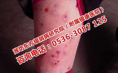 银屑病最新治疗方法研究与应用进展